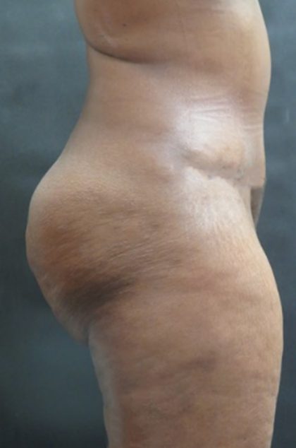 Tummy Tuck Before & After Patient #3419