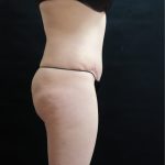 Mommy Makeover Before & After Patient #2644