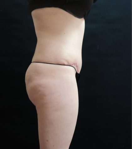 Mommy Makeover Before & After Patient #2644