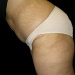 Tummy Tuck Before & After Patient #3433