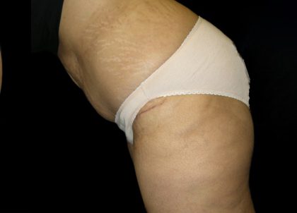 Tummy Tuck Before & After Patient #3433