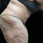 Tummy Tuck Before & After Patient #3352