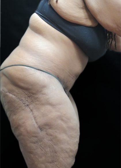 Tummy Tuck Before & After Patient #3352