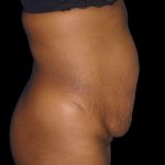 Mommy Makeover Before & After Patient #2442