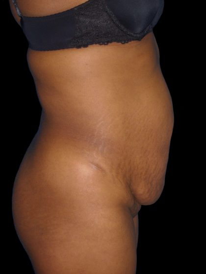 Mommy Makeover Before & After Patient #2442