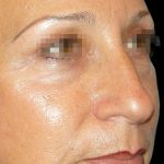 Browlift Before & After Patient #1466