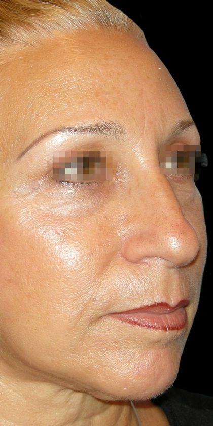 Browlift Before & After Patient #1466