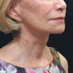 Levinelift Before & After Patient #2008