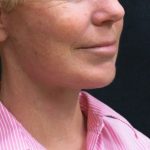 Levinelift Before & After Patient #1999