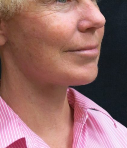Levinelift Before & After Patient #1999