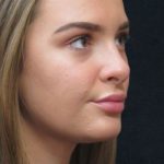 Rhinoplasty Before & After Patient #2926