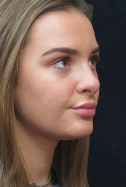 Rhinoplasty Before & After Patient #2926