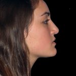 Rhinoplasty Before & After Patient #2919