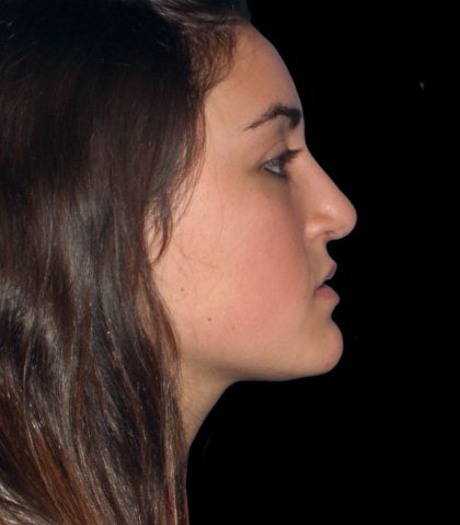 Rhinoplasty Before & After Patient #2919