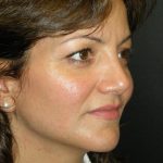 Rhinoplasty Before & After Patient #2805