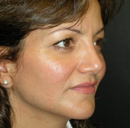 Rhinoplasty Before & After Patient #2805