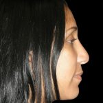 Rhinoplasty Before & After Patient #2912