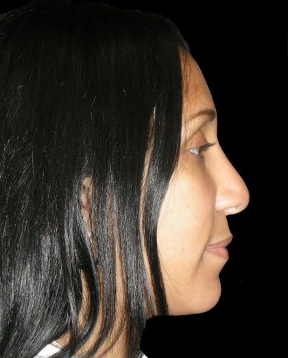Rhinoplasty Before & After Patient #2912