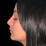 Rhinoplasty Before & After Patient #2819