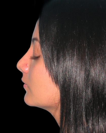 Rhinoplasty Before & After Patient #2819
