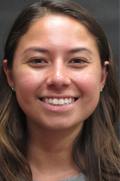 Rhinoplasty Before & After Patient #2798