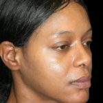 Rhinoplasty Before & After Patient #2812