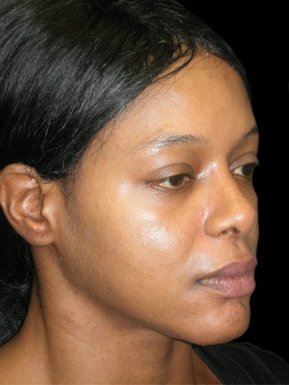 Rhinoplasty Before & After Patient #2812