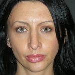 Rhinoplasty Before & After Patient #2877