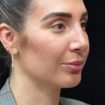 Rhinoplasty Before & After Patient #2851