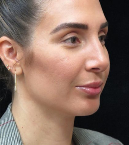 Rhinoplasty Before & After Patient #2851