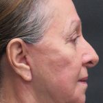 Rhinoplasty Before & After Patient #2891