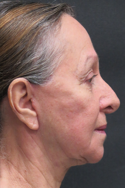 Rhinoplasty Before & After Patient #2891