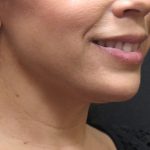 Chin Augmentation Before & After Patient #1561