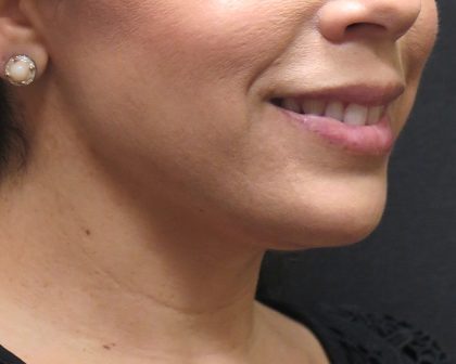 Chin Augmentation Before & After Patient #1561