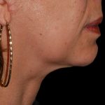 Chin Augmentation Before & After Patient #1566