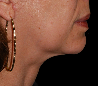 Chin Augmentation Before & After Patient #1566