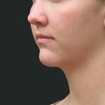 Fat Transfer Before & After Patient #1782