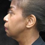 Fat Transfer Before & After Patient #1770