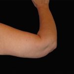 Arm Lift Before & After Patient #922