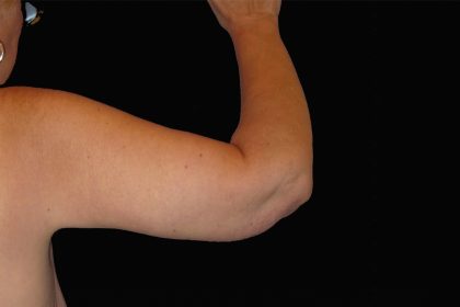 Arm Lift Before & After Patient #922