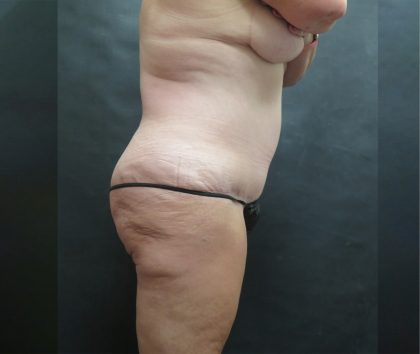 Mommy Makeover Before & After Patient #2542