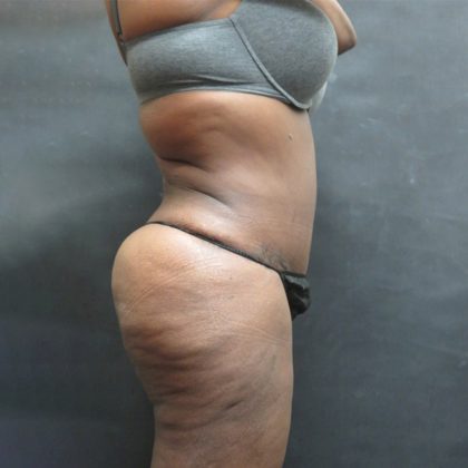 Mommy Makeover Before & After Patient #2503