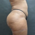 Mommy Makeover Before & After Patient #2618