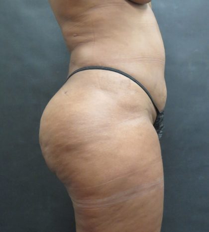 Mommy Makeover Before & After Patient #2618