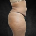 Mommy Makeover Before & After Patient #2587