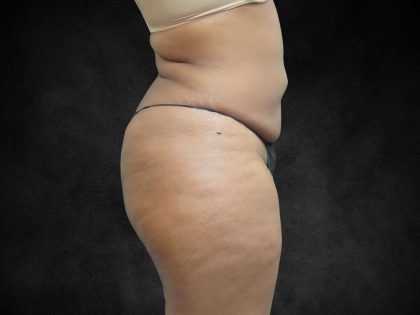 Mommy Makeover Before & After Patient #2587
