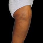 Thigh Lift Before & After Patient #3137