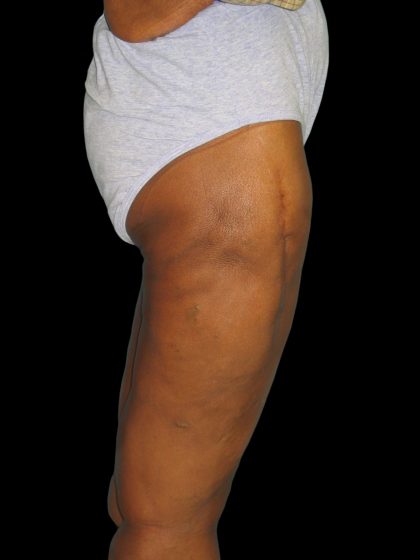 Thigh Lift Before & After Patient #3137