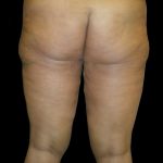 Thigh Lift Before & After Patient #3128