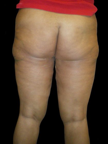 Thigh Lift Before & After Patient #3128